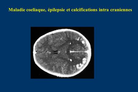 Maladie coeliaque, épilepsie et calcifications intra craniennes