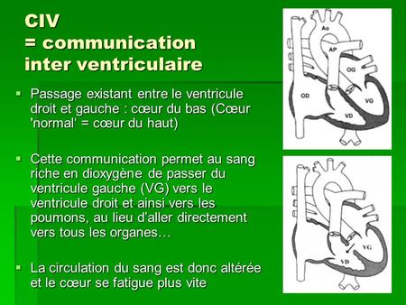 CIV = communication inter ventriculaire