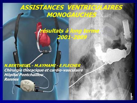 ASSISTANCES VENTRICULAIRES MONOGAUCHES résultats à long terme 2001-2009 N.BERTHEUIL - M.AYMAMI - E.FLECHER Chirurgie thoracique et cardio-vasculaire Hôpital.