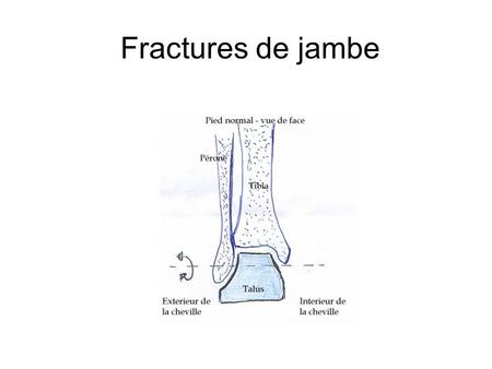 Fractures de jambe.