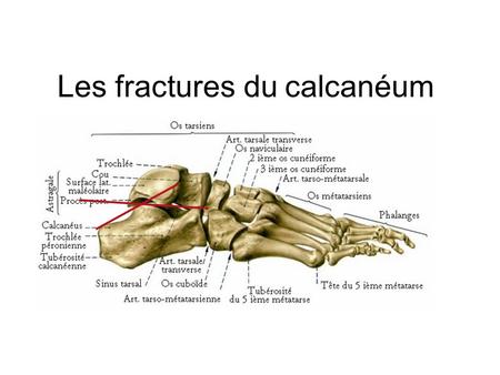 Les fractures du calcanéum