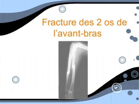 Fracture des 2 os de l’avant-bras