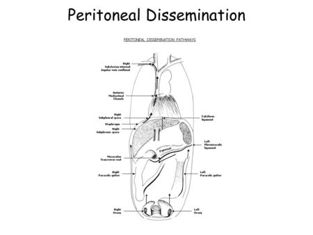 Peritoneal Dissemination
