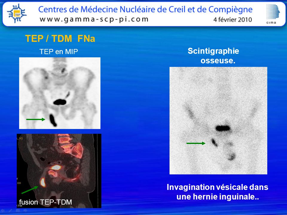 x ray findings in lymphoma