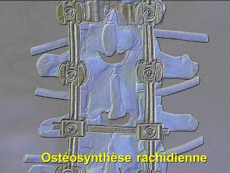 Ostéosynthèse rachidienne