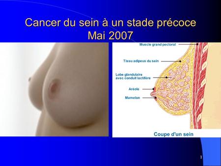 Cancer du sein à un stade précoce Mai 2007