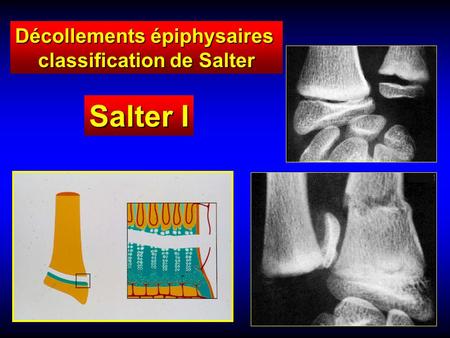 Salter I Décollements épiphysaires classification de Salter.