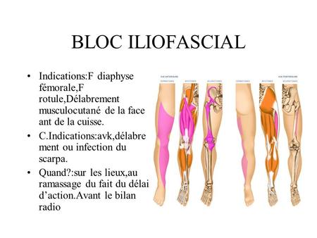 BLOC ILIOFASCIAL Indications:F diaphyse fémorale,F rotule,Délabrement musculocutané de la face ant de la cuisse. C.Indications:avk,délabrement ou infection.