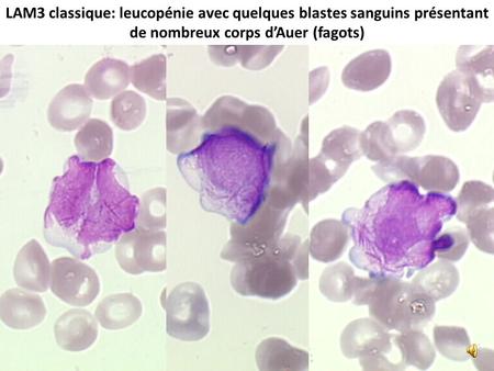 LAM3 classique: leucopénie avec quelques blastes sanguins présentant de nombreux corps d’Auer (fagots)