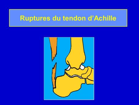 Ruptures du tendon d’Achille
