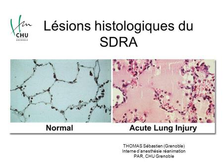 Lésions histologiques du SDRA