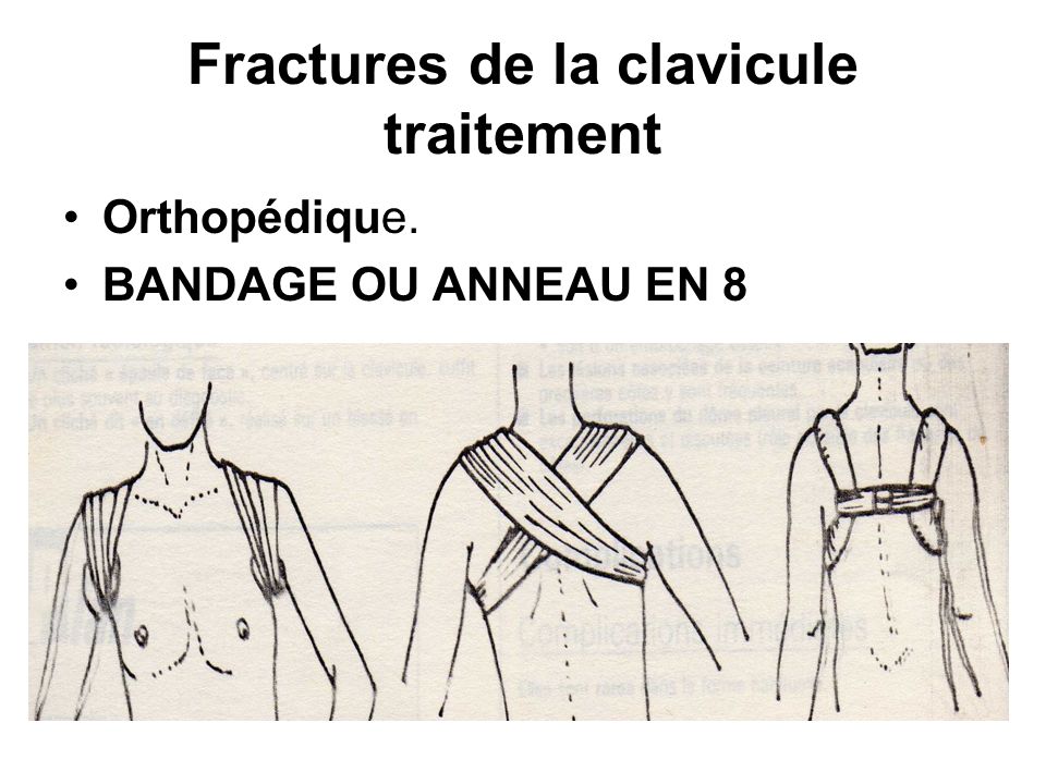 Trouble de stress post-traumatique Wikipdia