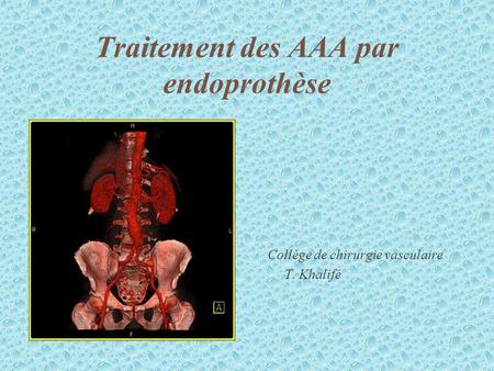 Traitement des AAA par endoprothèse