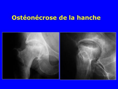 Ostéonécrose de la hanche