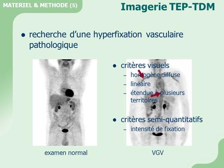 Imagerie TEP-TDM recherche d’une hyperfixation vasculaire pathologique
