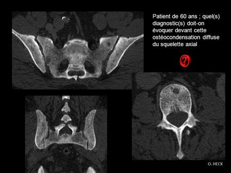 Patient de 60 ans ; quel(s) diagnostic(s) doit-on évoquer devant cette ostéocondensation diffuse du squelette axial O. HECK.