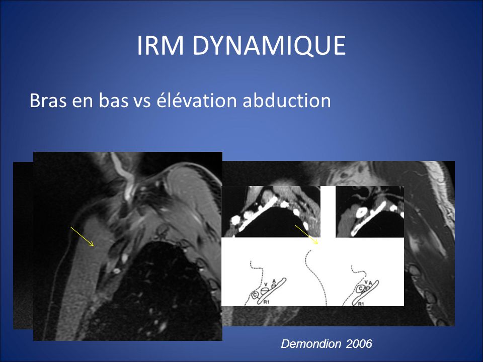 IRM DYNAMIQUE Bras en bas vs élévation abduction Demondion 2006