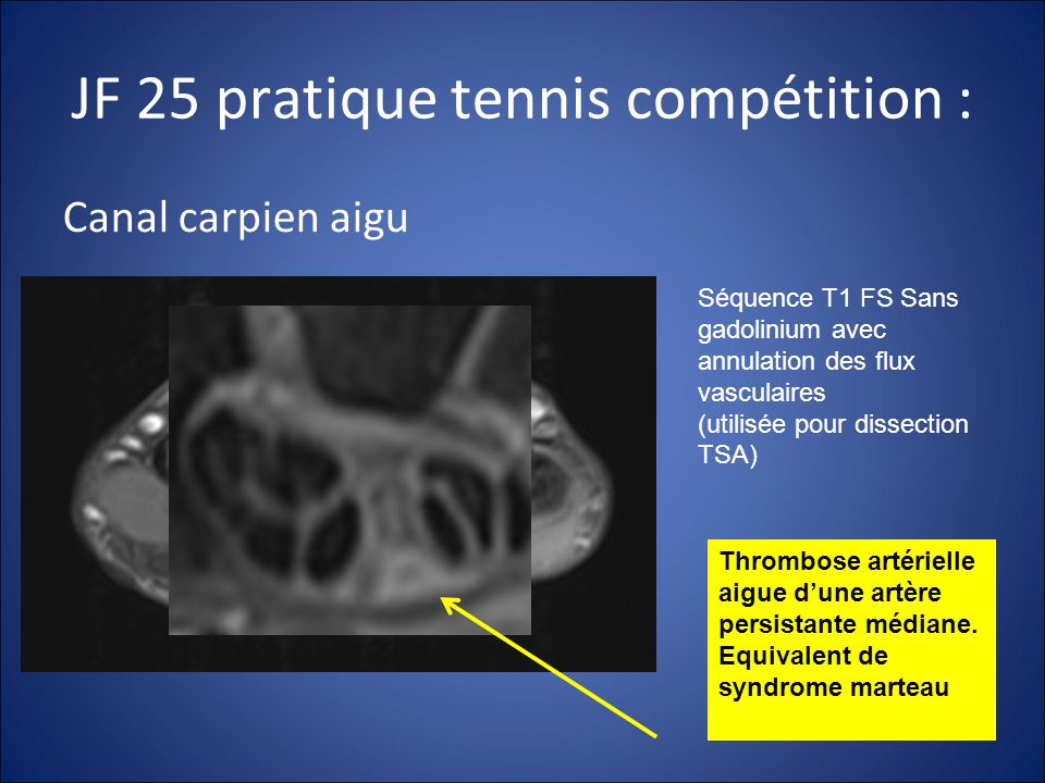 JF 25 pratique tennis compétition :