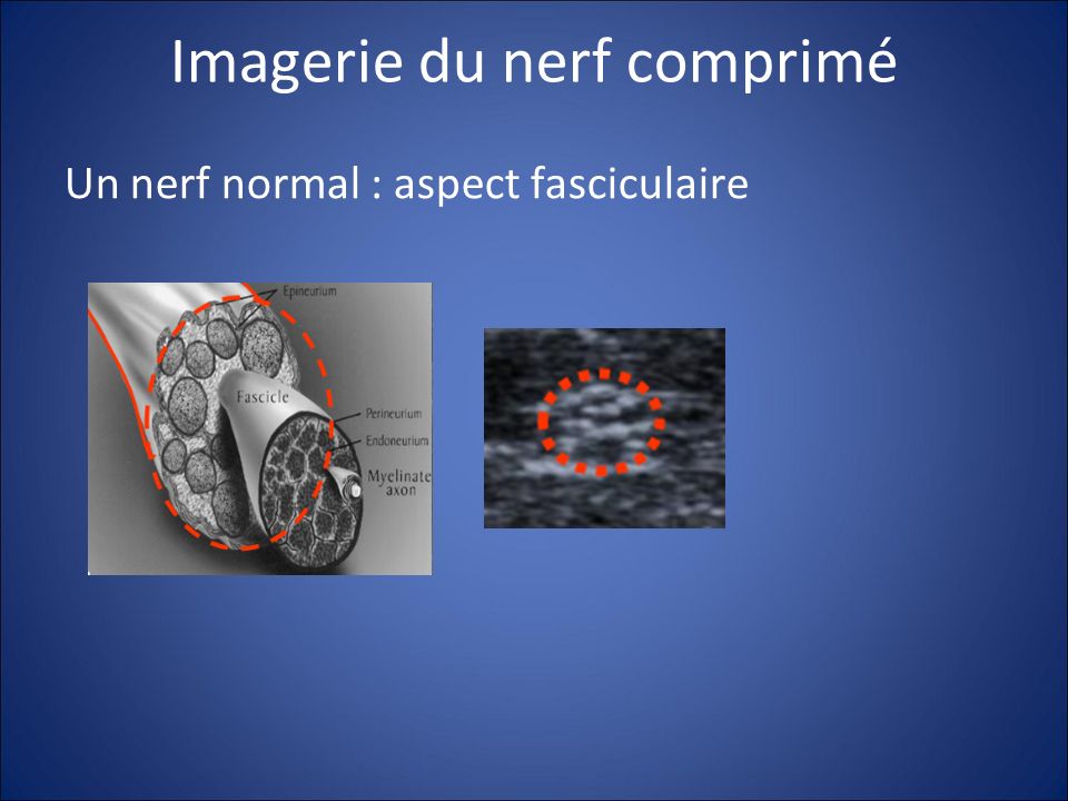 Imagerie du nerf comprimé