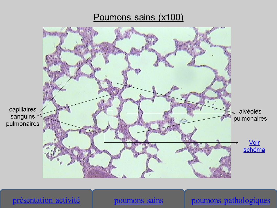 Poumons sains (x100) capillaires alvéoles sanguins pulmonaires