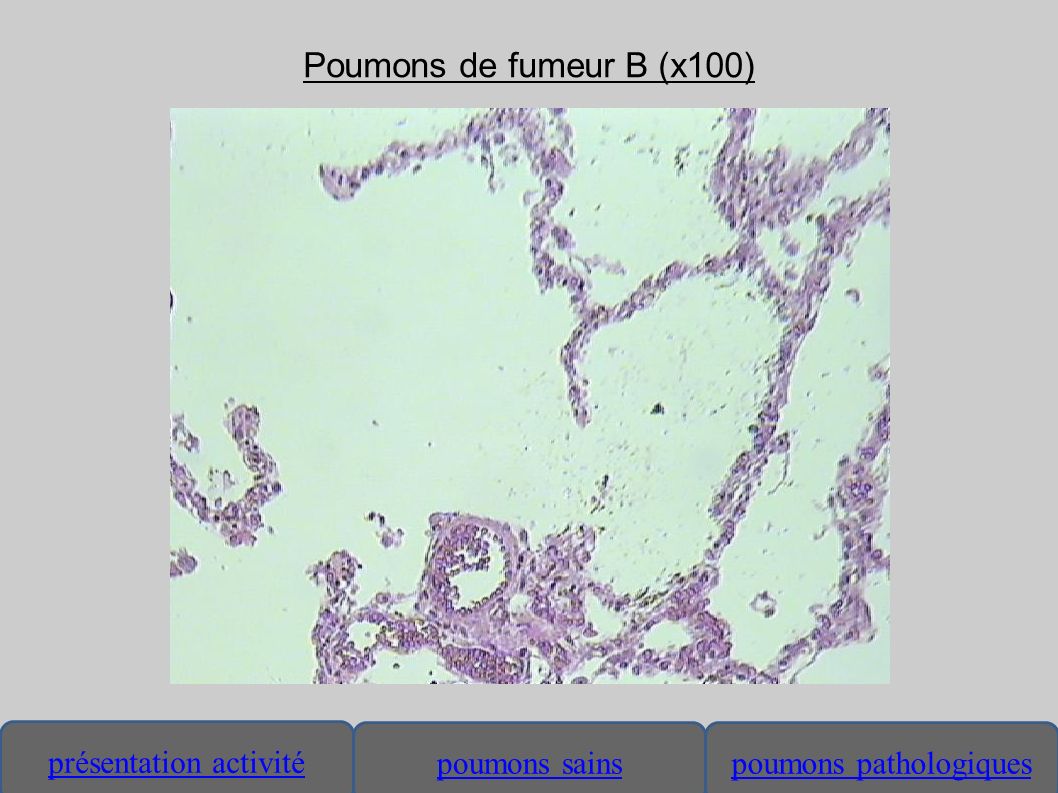 Poumons de fumeur B (x100)