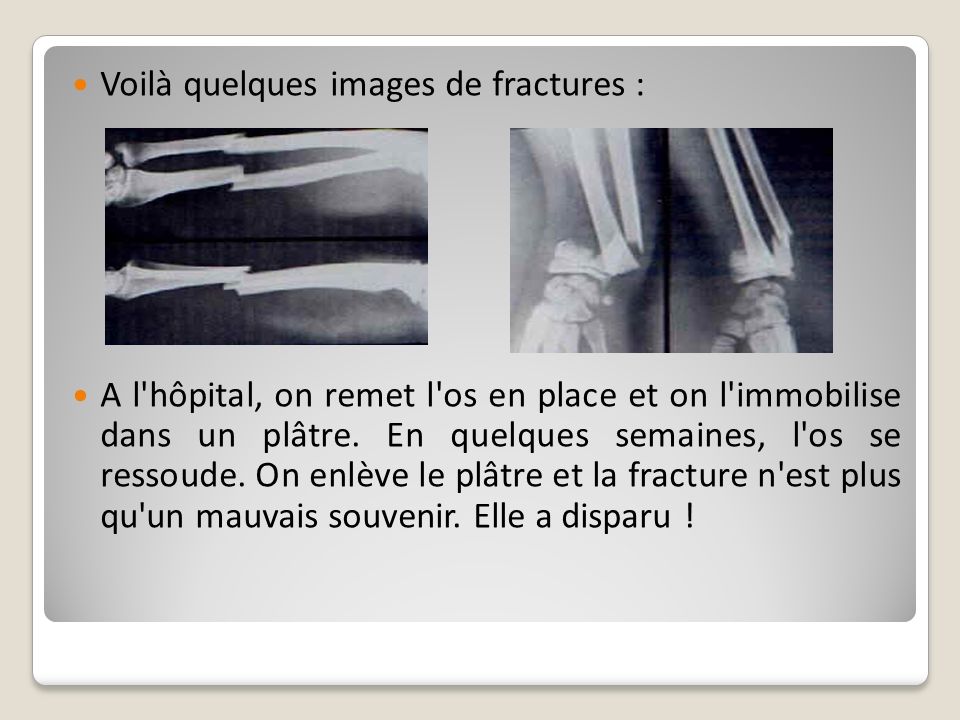 Voilà quelques images de fractures :