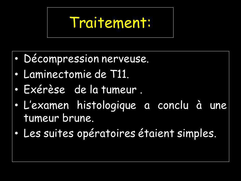 Traitement: Décompression nerveuse. Laminectomie de T11.