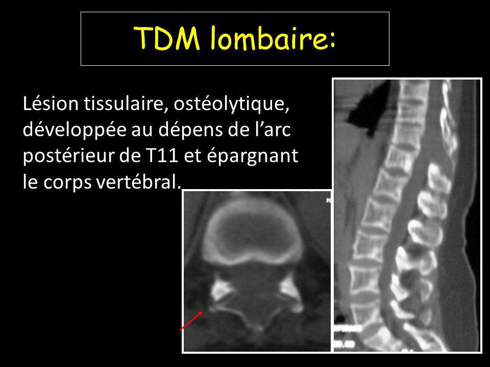 TDM lombaire: Lésion tissulaire, ostéolytique, développée au dépens de l’arc postérieur de T11 et épargnant le corps vertébral.