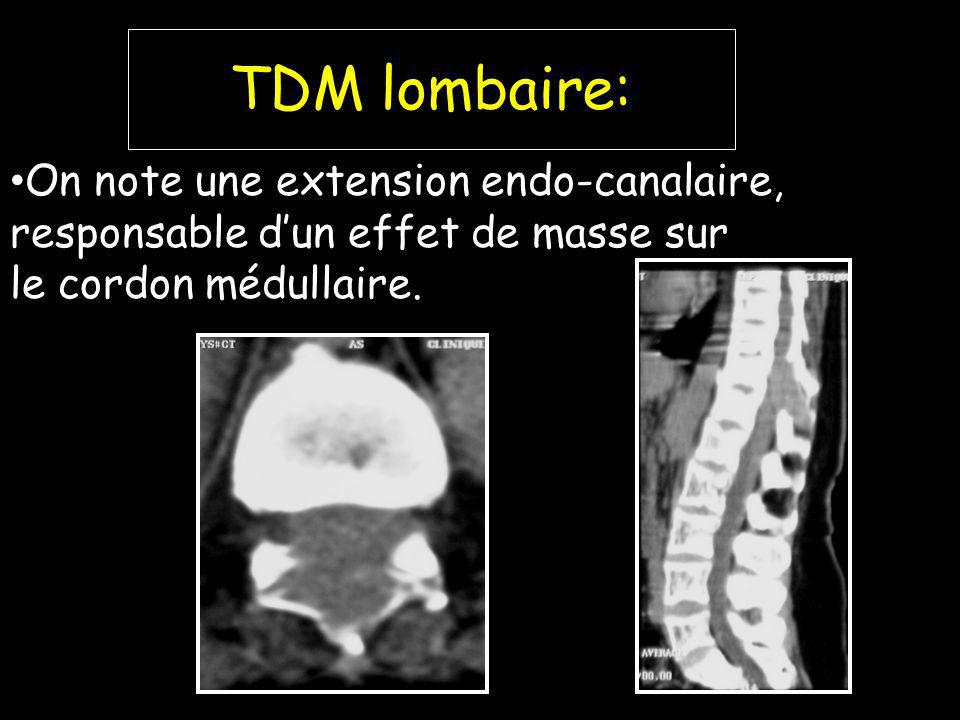 TDM lombaire: On note une extension endo-canalaire, responsable d’un effet de masse sur.