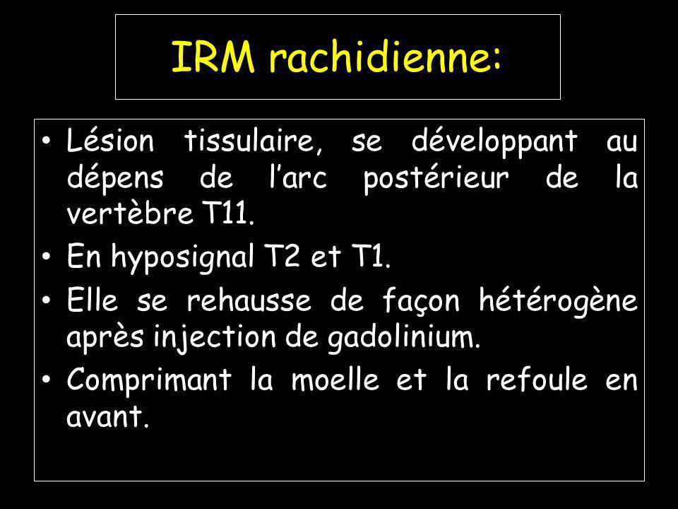 IRM rachidienne: Lésion tissulaire, se développant au dépens de l’arc postérieur de la vertèbre T11.