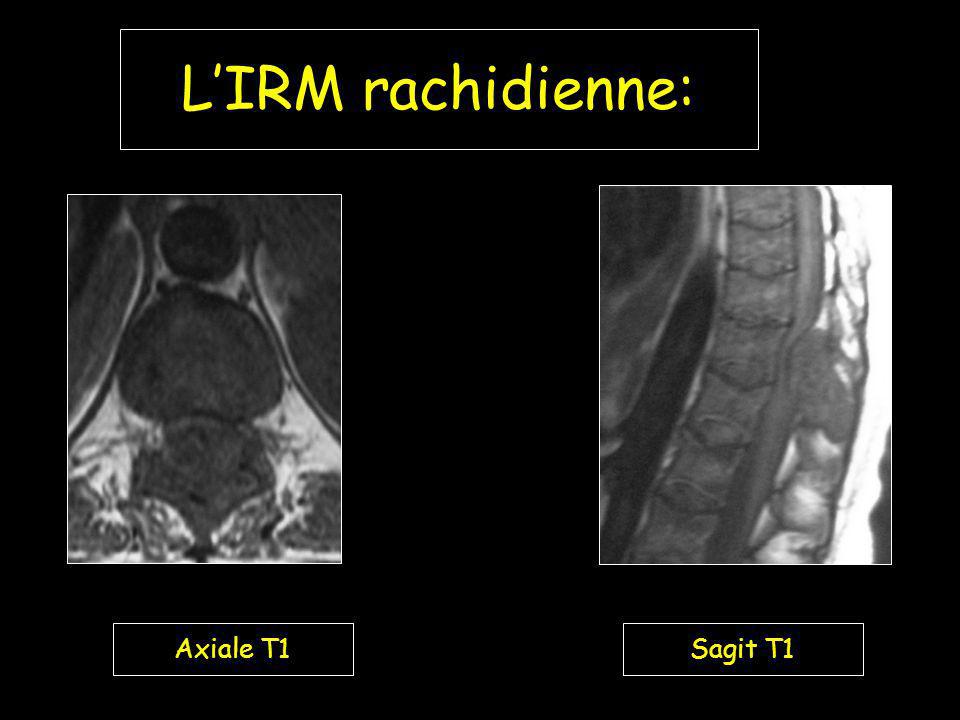 L’IRM rachidienne: Axiale T1 Sagit T1