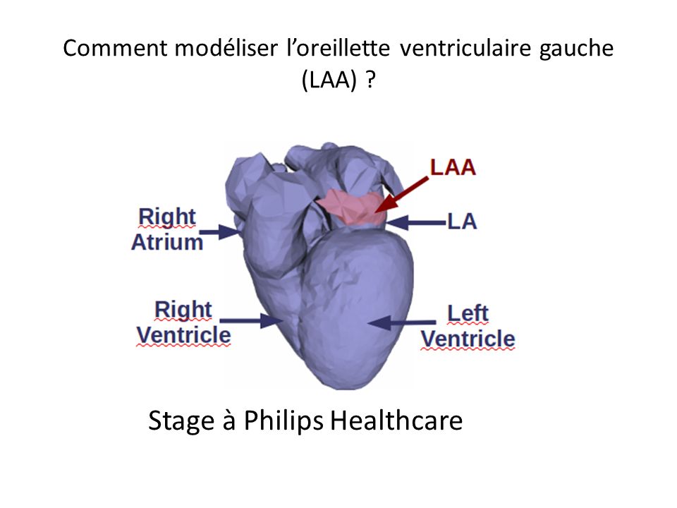 Comment modéliser l’oreillette ventriculaire gauche (LAA)