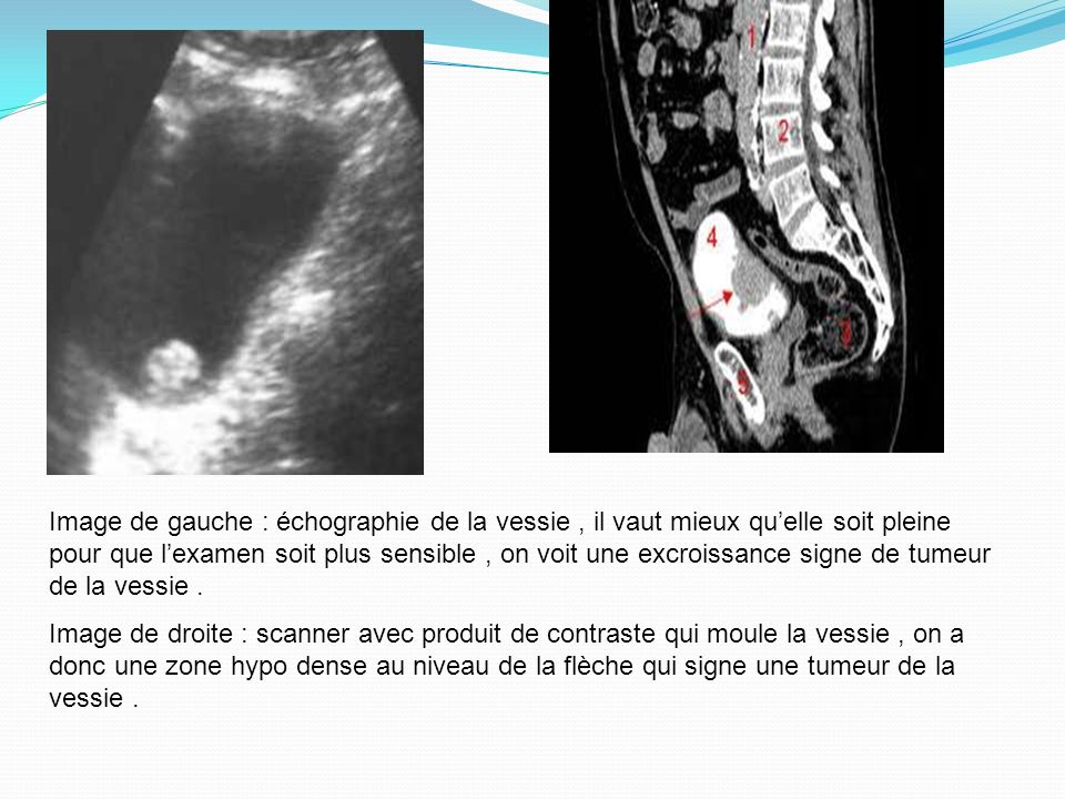 Image de gauche : échographie de la vessie , il vaut mieux qu’elle soit pleine pour que l’examen soit plus sensible , on voit une excroissance signe de tumeur de la vessie .