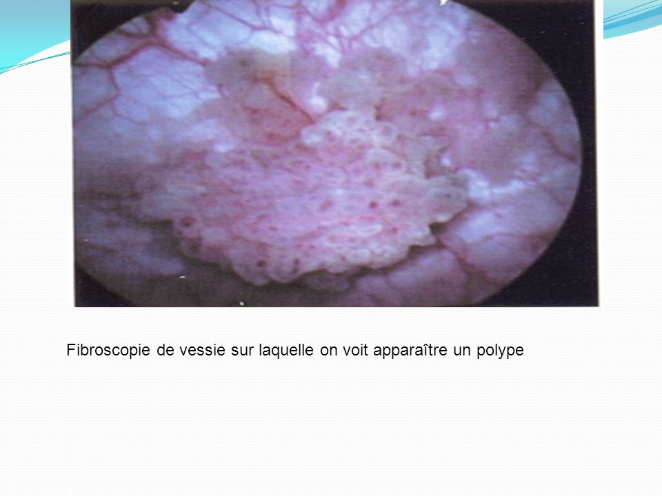 Fibroscopie de vessie sur laquelle on voit apparaître un polype