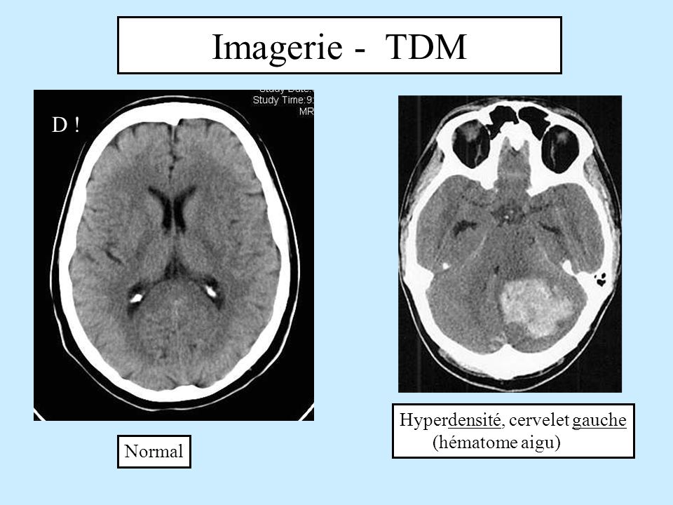 Imagerie - TDM D ! Hyperdensité, cervelet gauche (hématome aigu)