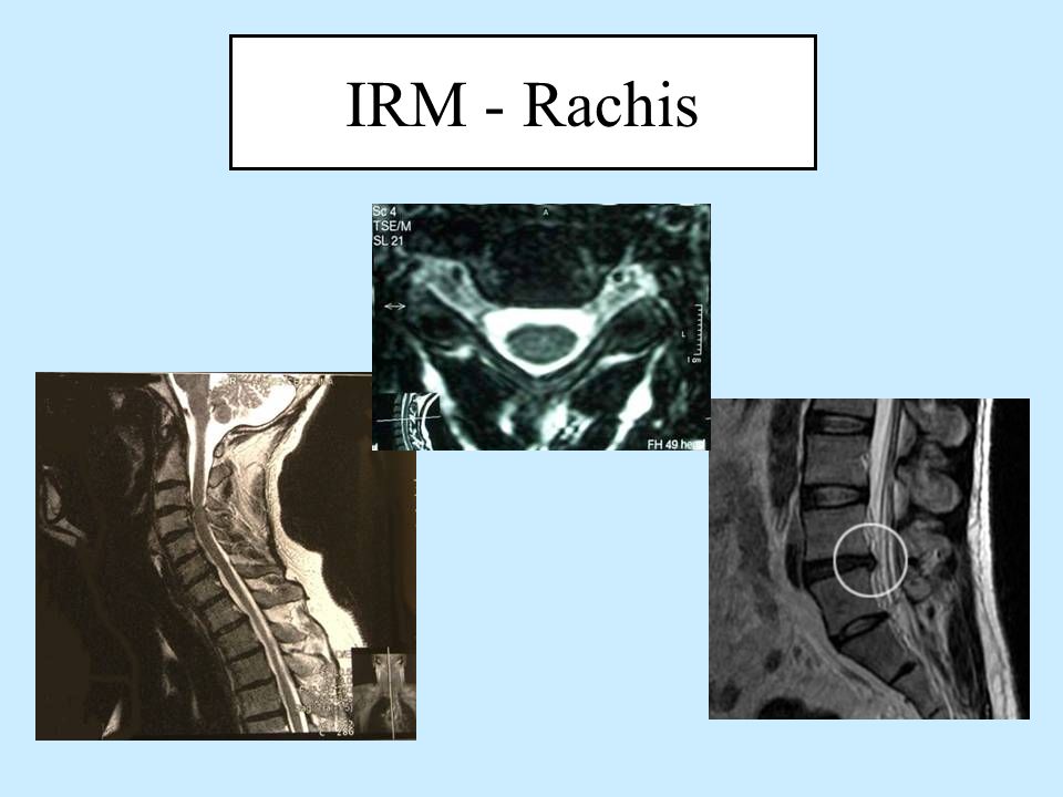 IRM - Rachis