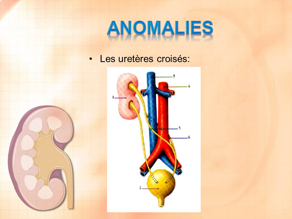 ANOMALIES Les uretères croisés:
