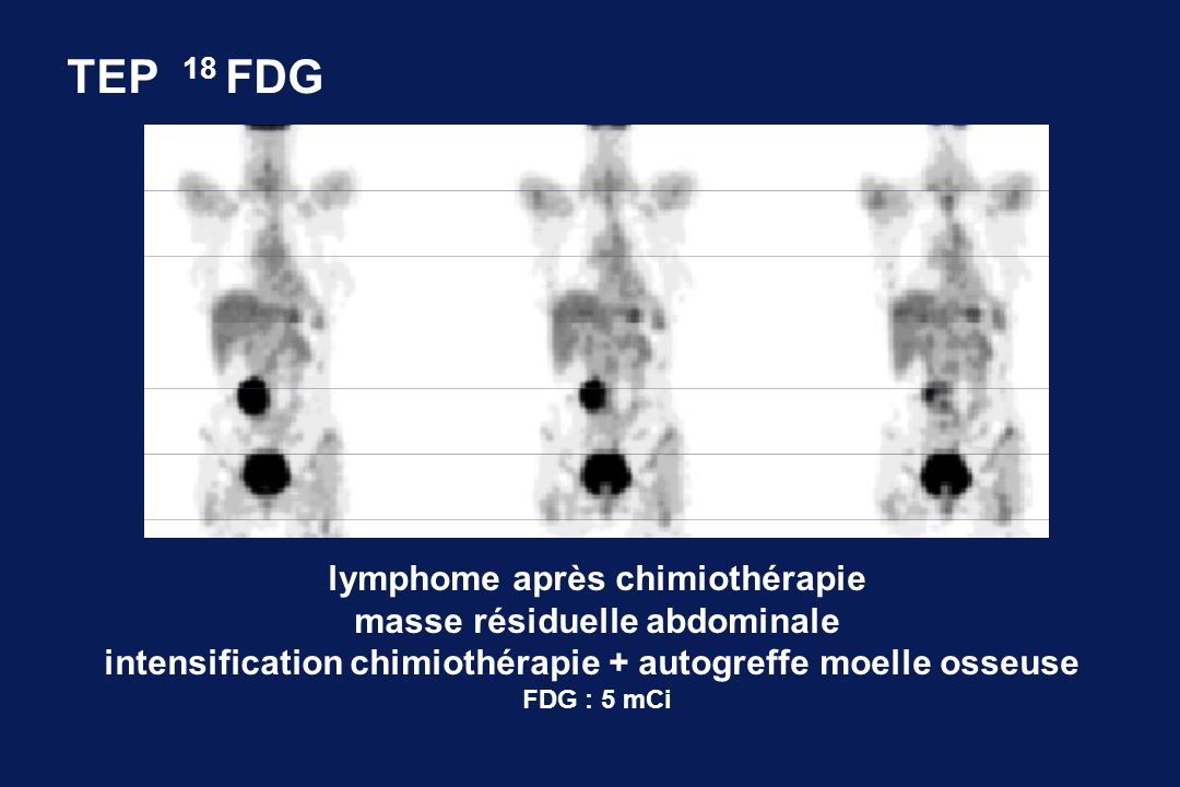 TEP 18 FDG lymphome après chimiothérapie masse résiduelle abdominale
