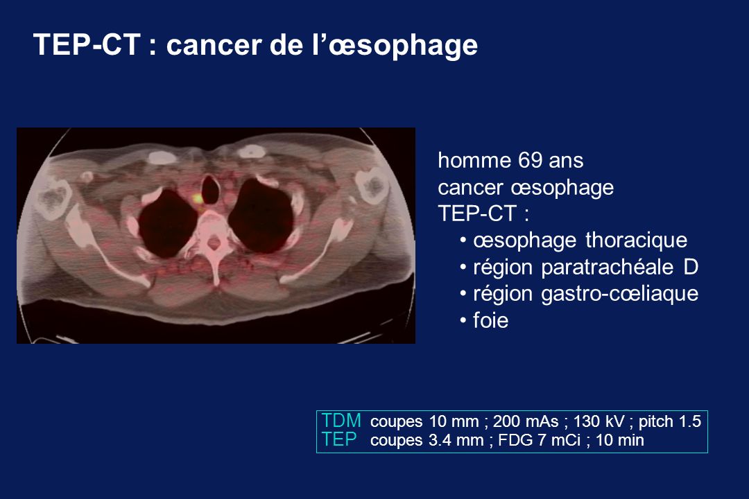 TEP-CT : cancer de l’œsophage