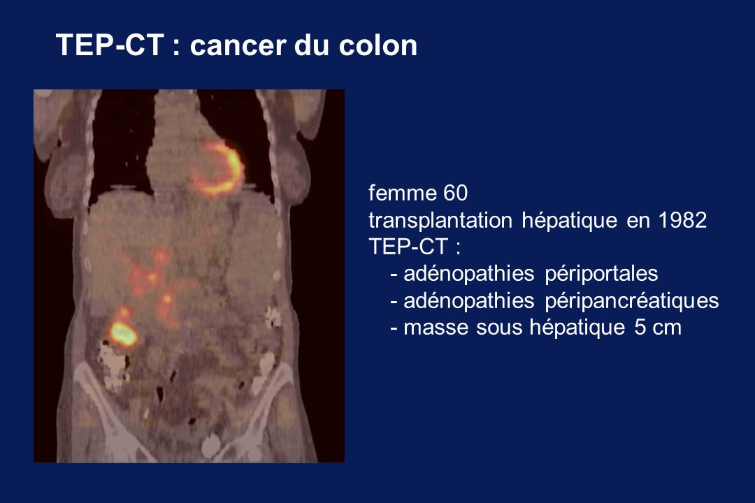 TEP-CT : cancer du colon