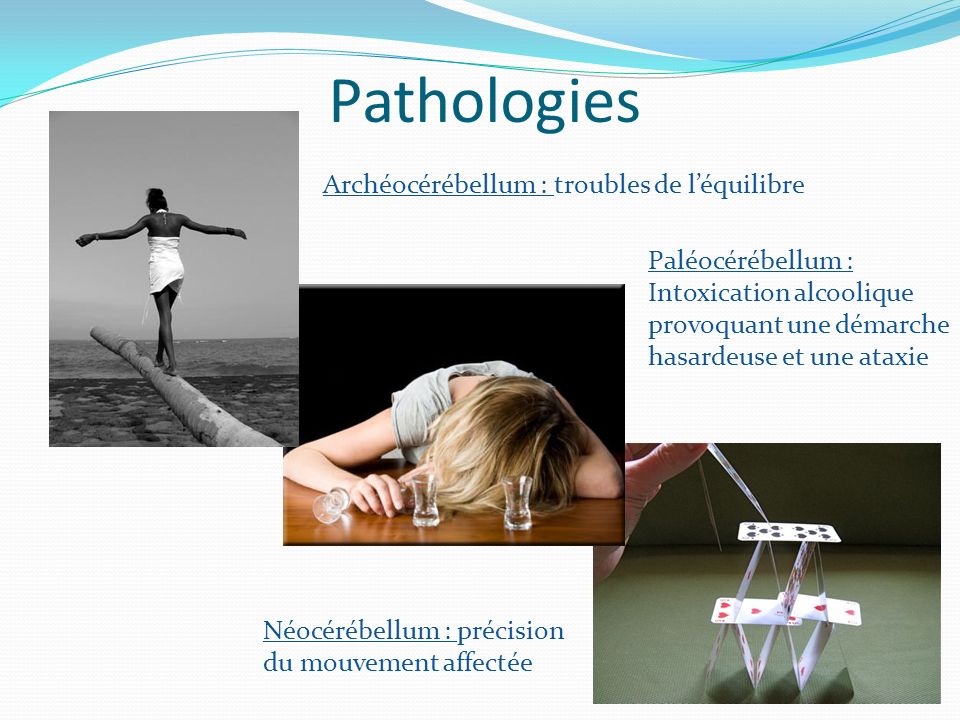 Pathologies Archéocérébellum : troubles de l’équilibre