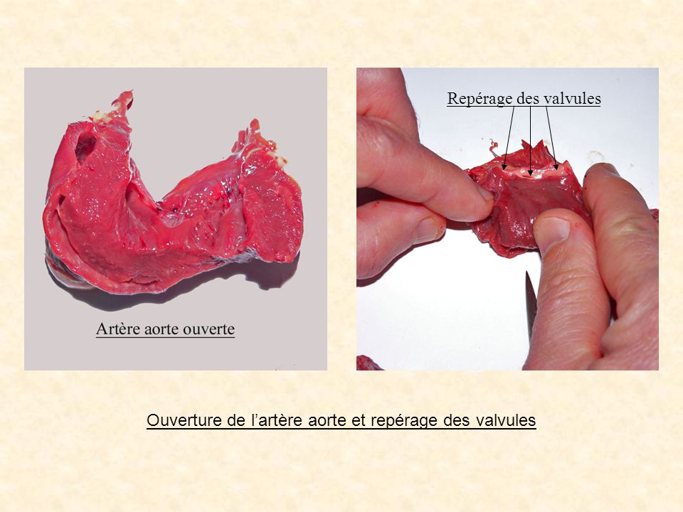 Ouverture de l’artère aorte et repérage des valvules