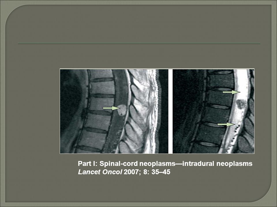 Part I: Spinal-cord neoplasms—intradural neoplasms