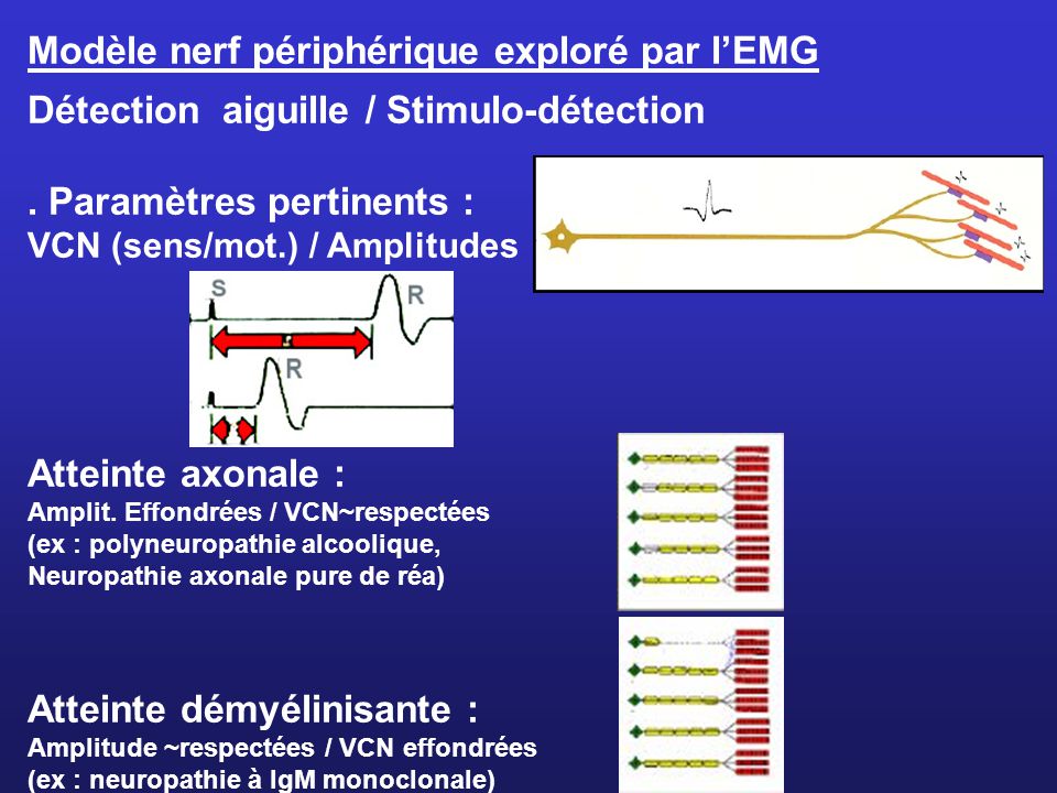 Modèle nerf périphérique exploré par l’EMG