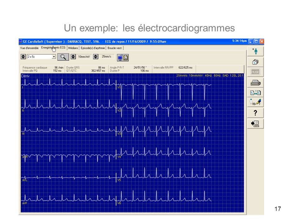 Un exemple: les électrocardiogrammes