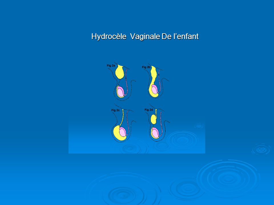Hydrocèle Vaginale De l’enfant