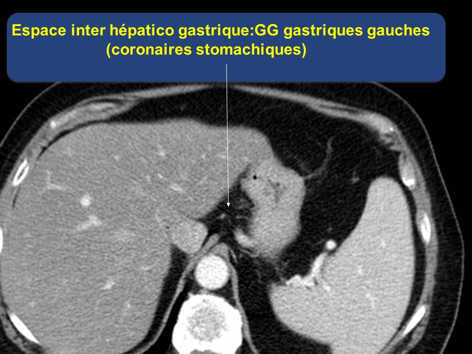 Espace inter hépatico gastrique:GG gastriques gauches