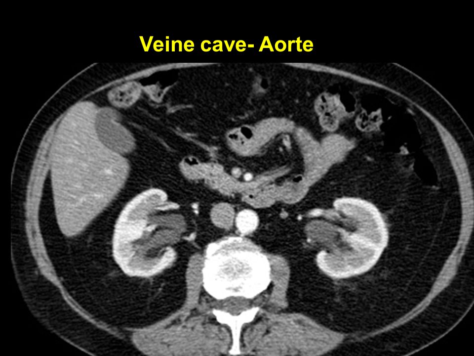 Veine cave- Aorte