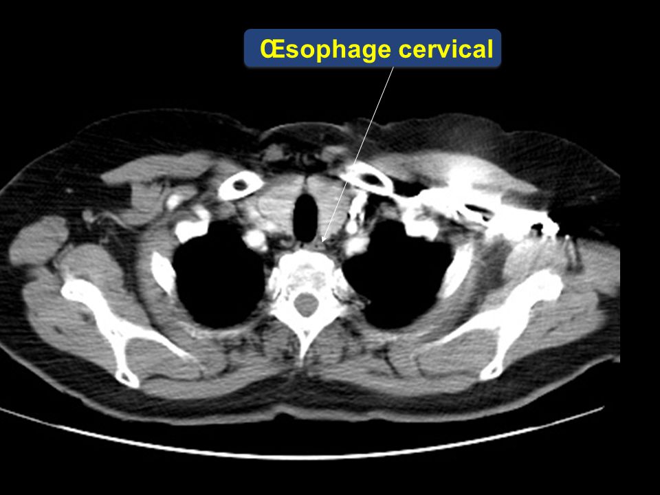 Œsophage cervical