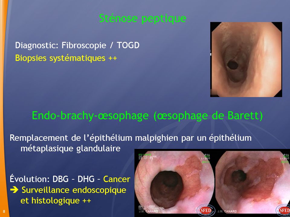 Endo-brachy-œsophage (œsophage de Barett)